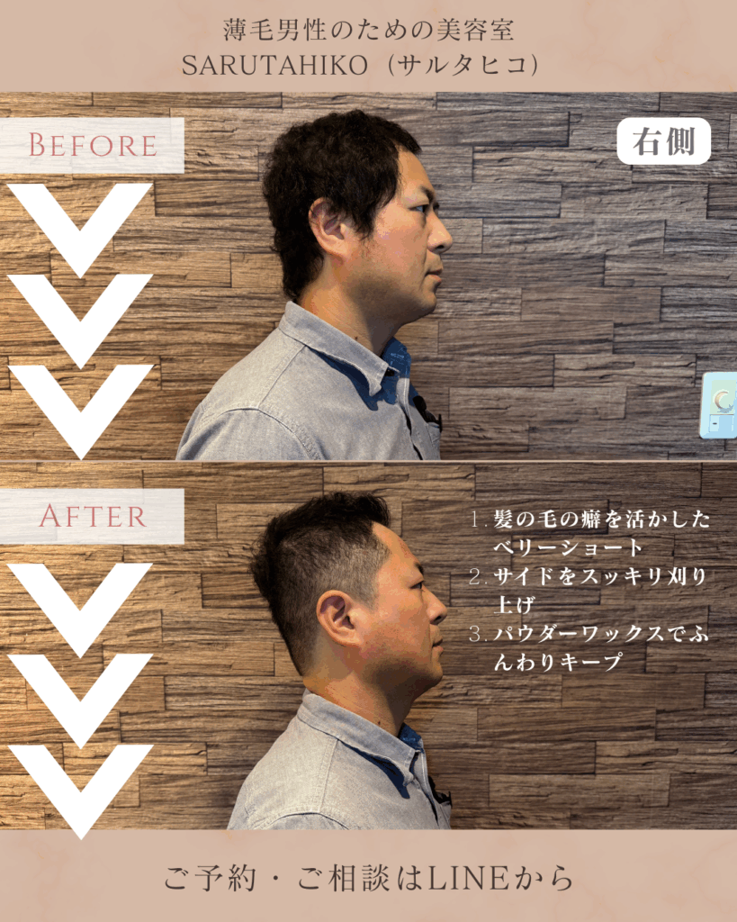 40歳のU字はげの薄毛男性のカット前後の写真(右側)