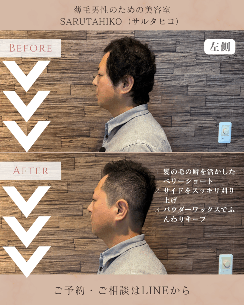 40歳のU字はげの薄毛男性のカット前後の写真(左側)