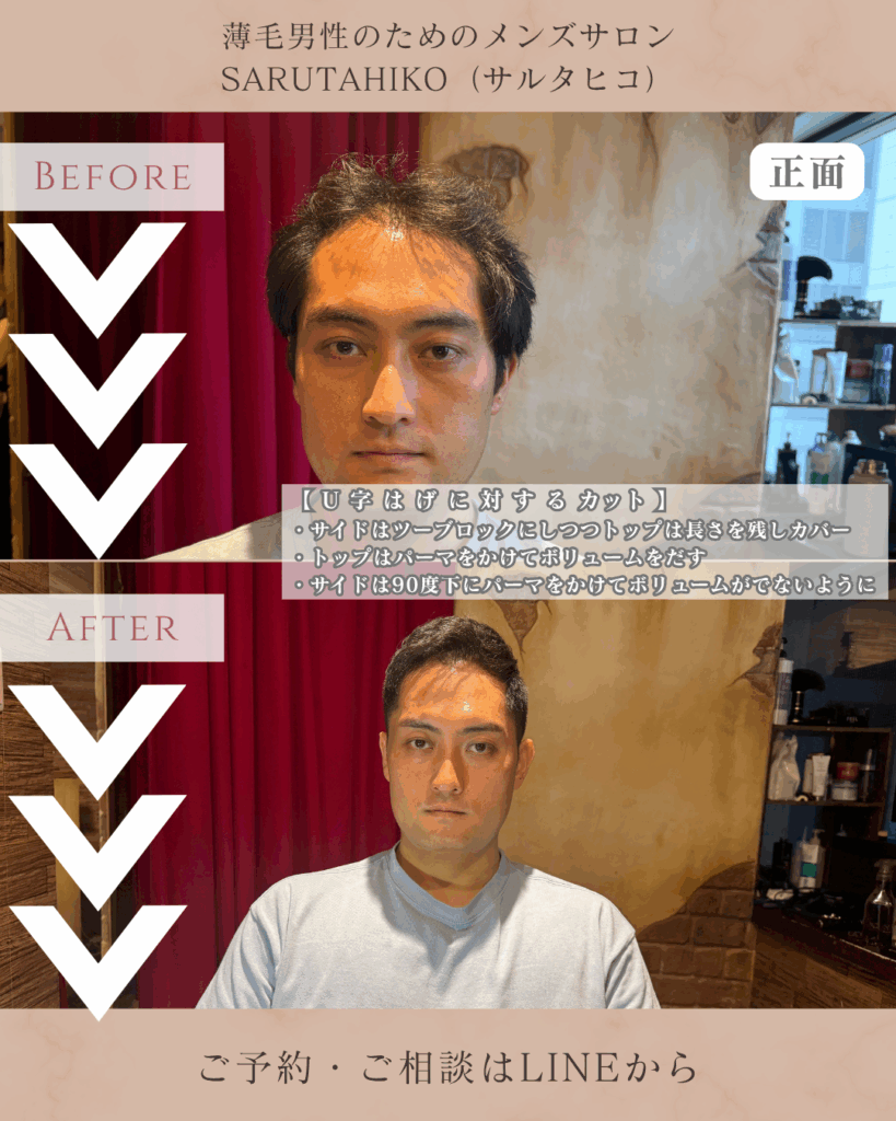 U字ハゲに似合うパーマの髪型_正面