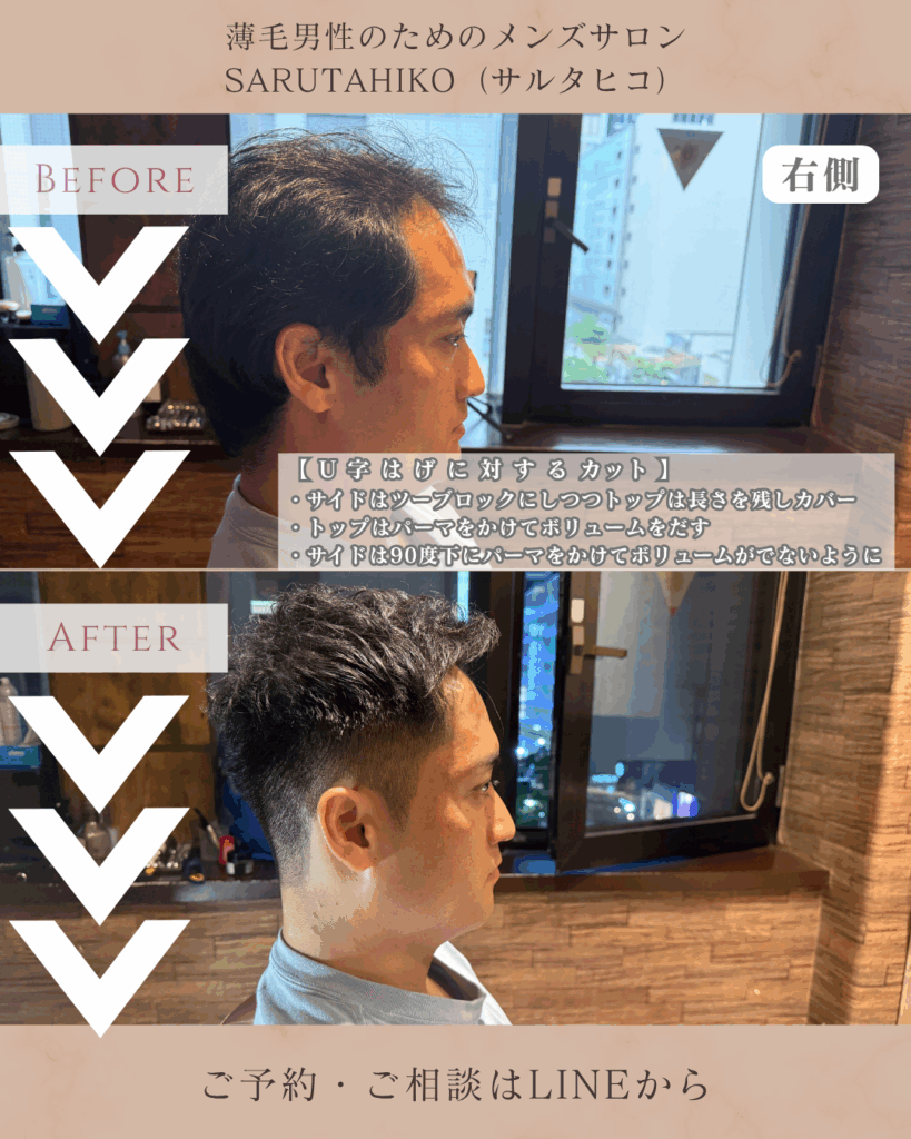 U字ハゲに似合う髪型の右側からの写真_サイドを刈り上げている様子がよく分かる
