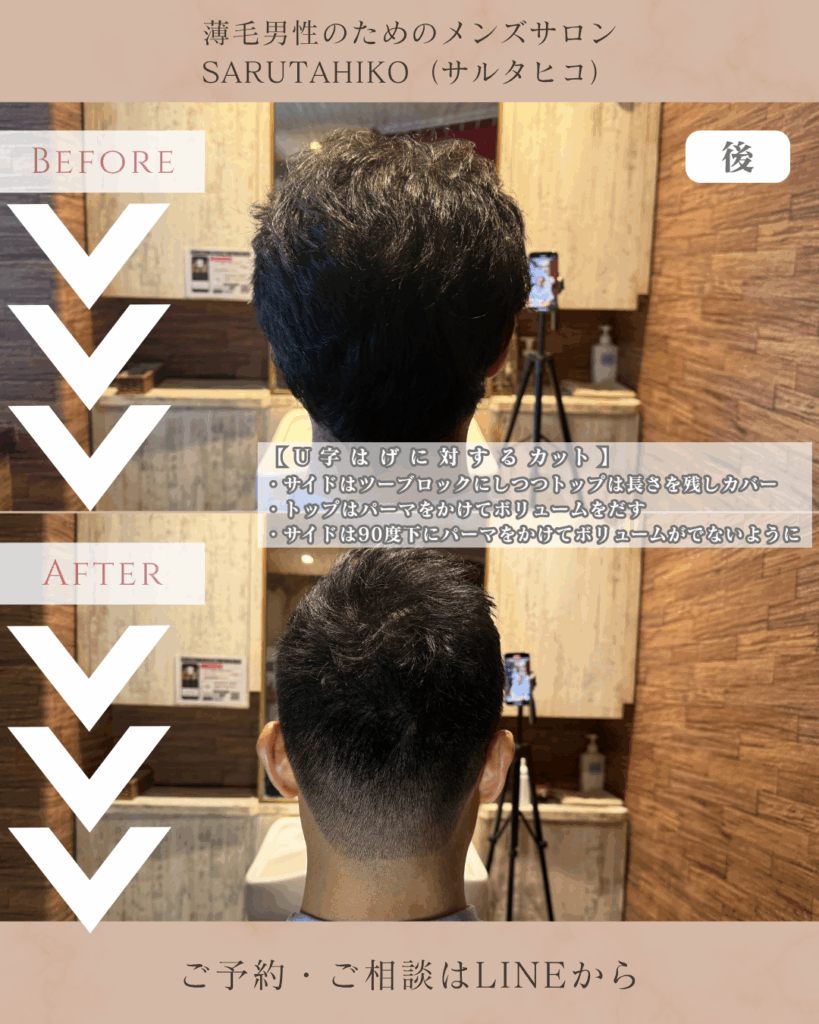 U字ハゲに似合う髪型の後からの写真