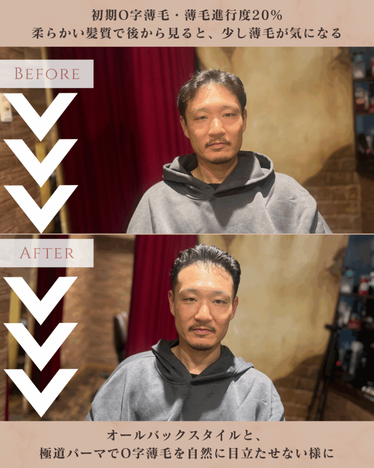 【薄毛専門理容師監修】頭頂部ハゲの対策とおすすめ髪型｜O字はげでも自然にカバーする方法