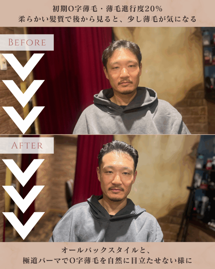 O字薄毛(ハゲ)に対して、極道パーマをご提案