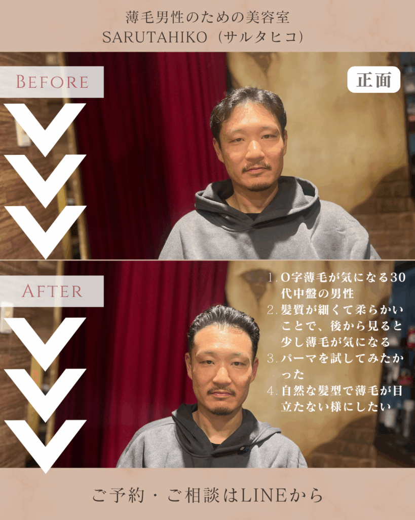 O字薄毛（ハゲ）に対して、極道パーマをご提案_正面