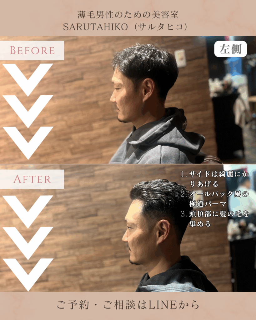 O字薄毛(ハゲ)に対して、極道パーマをご提案_左