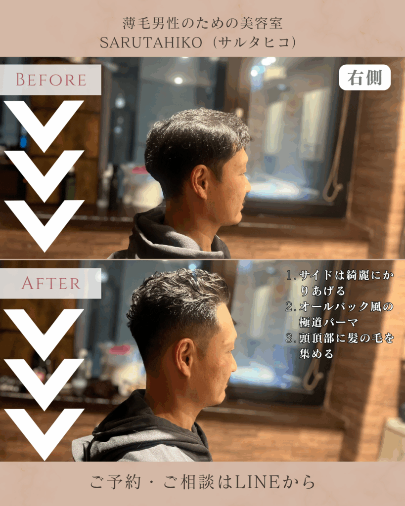 O字薄毛(ハゲ)に対して、極道パーマをご提案_右側