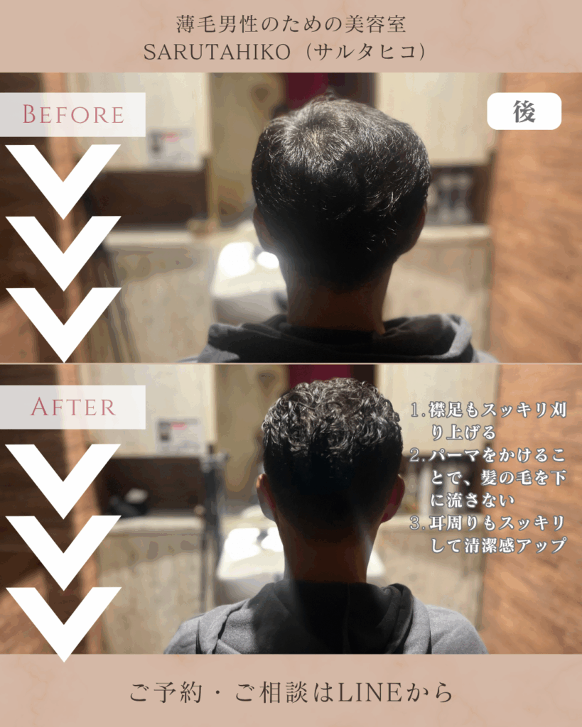 O字薄毛(ハゲ)に対して、極道パーマをご提案_後