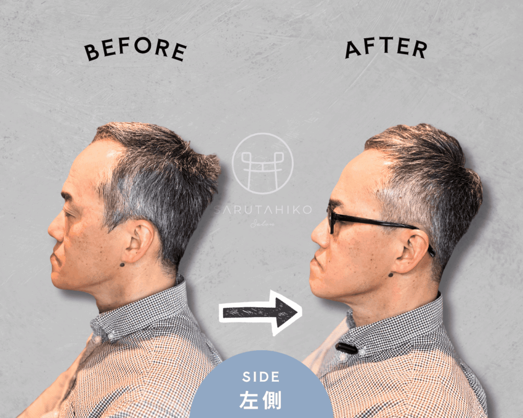 50歳のM字はげの薄毛男性のカット前後の写真(左側)