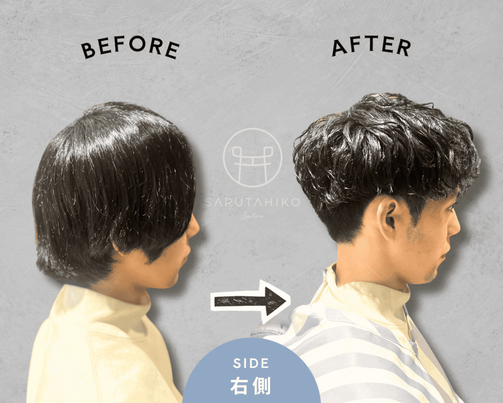 30代の前髪が割れる悩みの薄毛男性のカット前後の写真（右側）