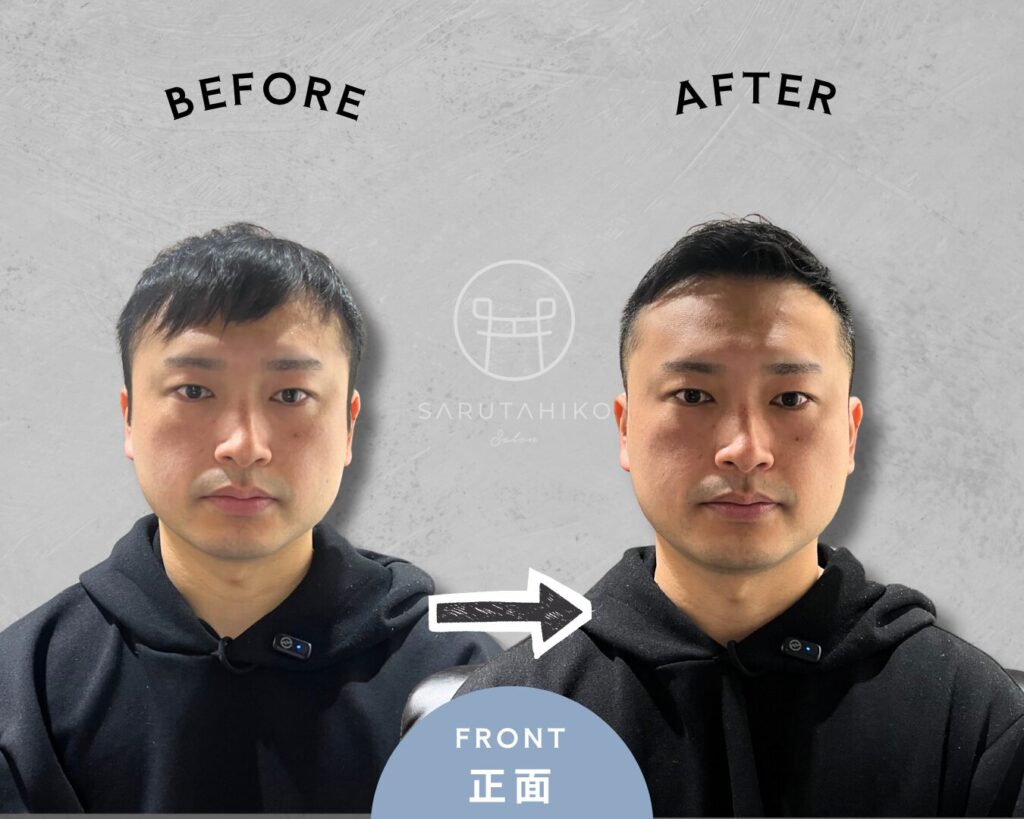 30代の前髪が割れる悩みの薄毛男性のカット前後の写真(正面)