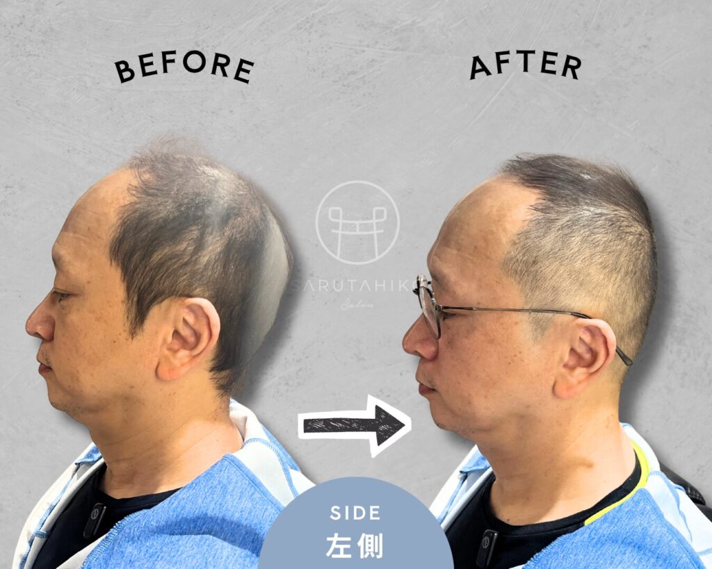 50代の前頭部の薄毛にお悩みの薄毛男性のカット前後の写真(左側)