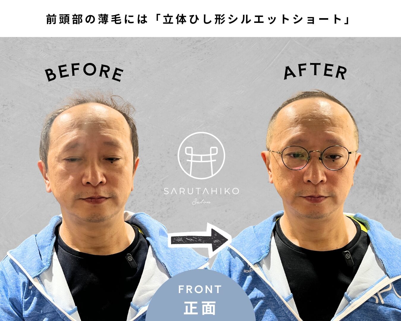 薄毛 の 芸能人