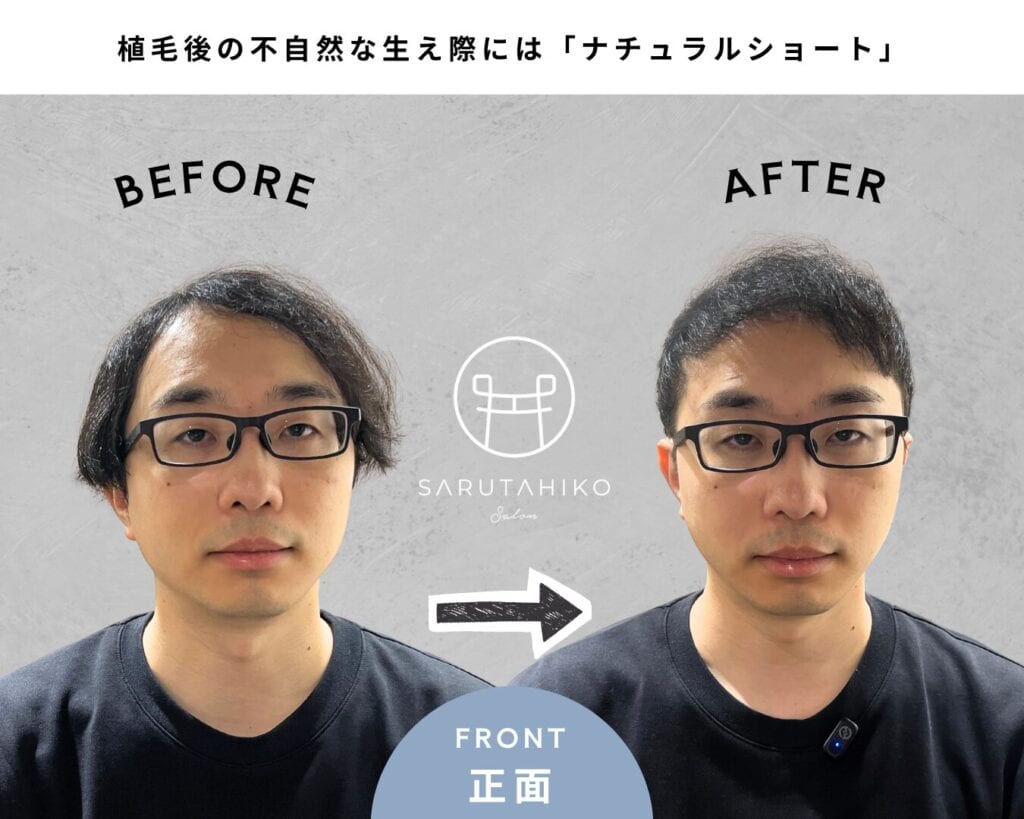 植毛後の不自然な生え際にはナチュラルショート