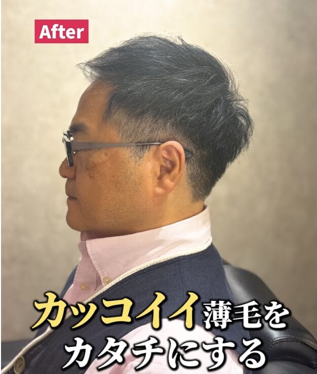 トップのボリュームにお悩みの薄毛男性