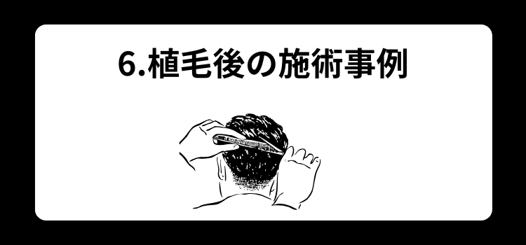 植毛後　薄毛専門理容室　６