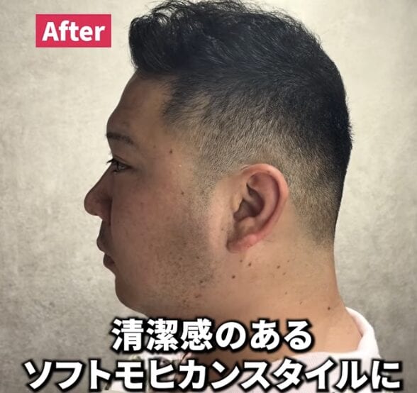 トップのボリュームにお悩みの薄毛男性