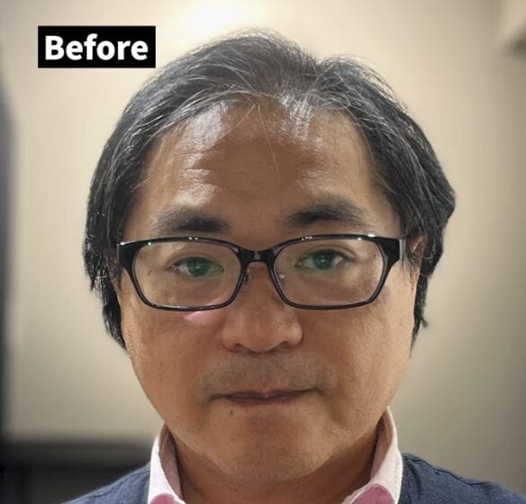 トップのボリュームにお悩みの薄毛男性