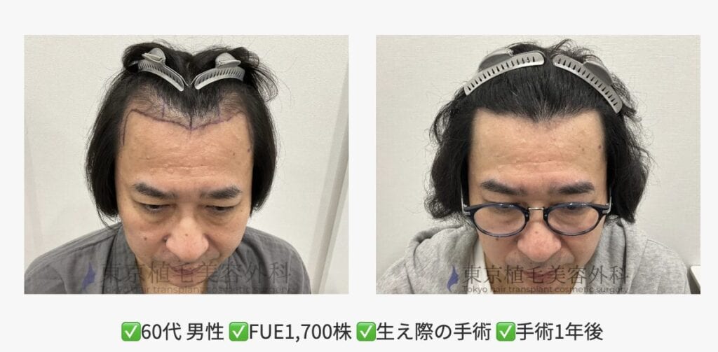 60代男性　症例