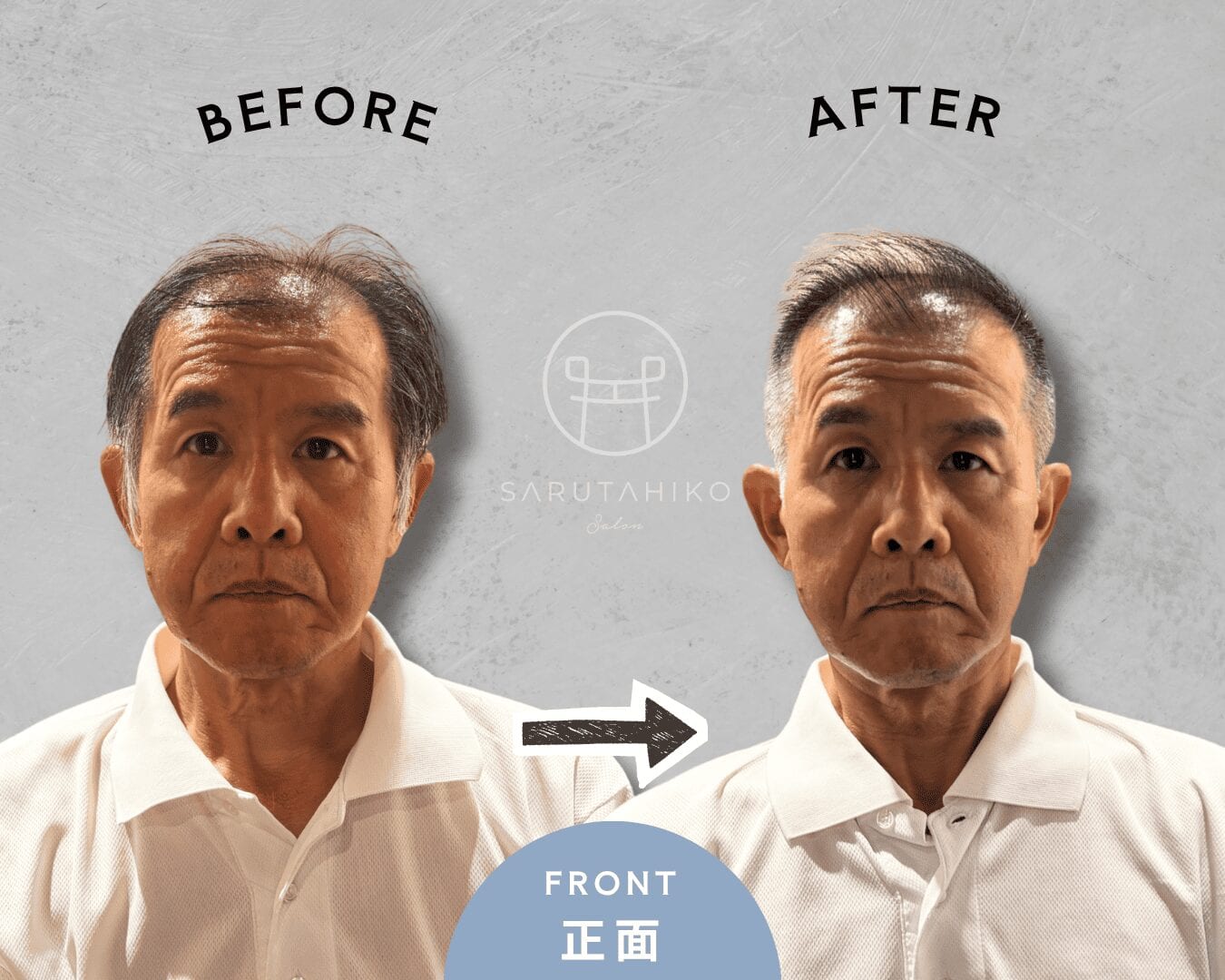 横の膨らみと上部の薄さにお悩みの50代男性Kさんのカット前後の写真（正面）