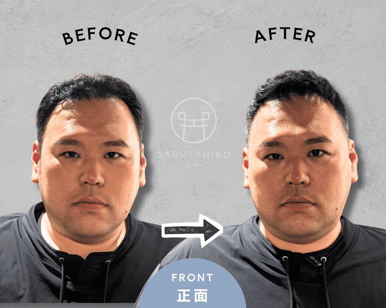 頭頂部薄毛を自然にカバーした30代男性M様のカット前後の写真（正面）