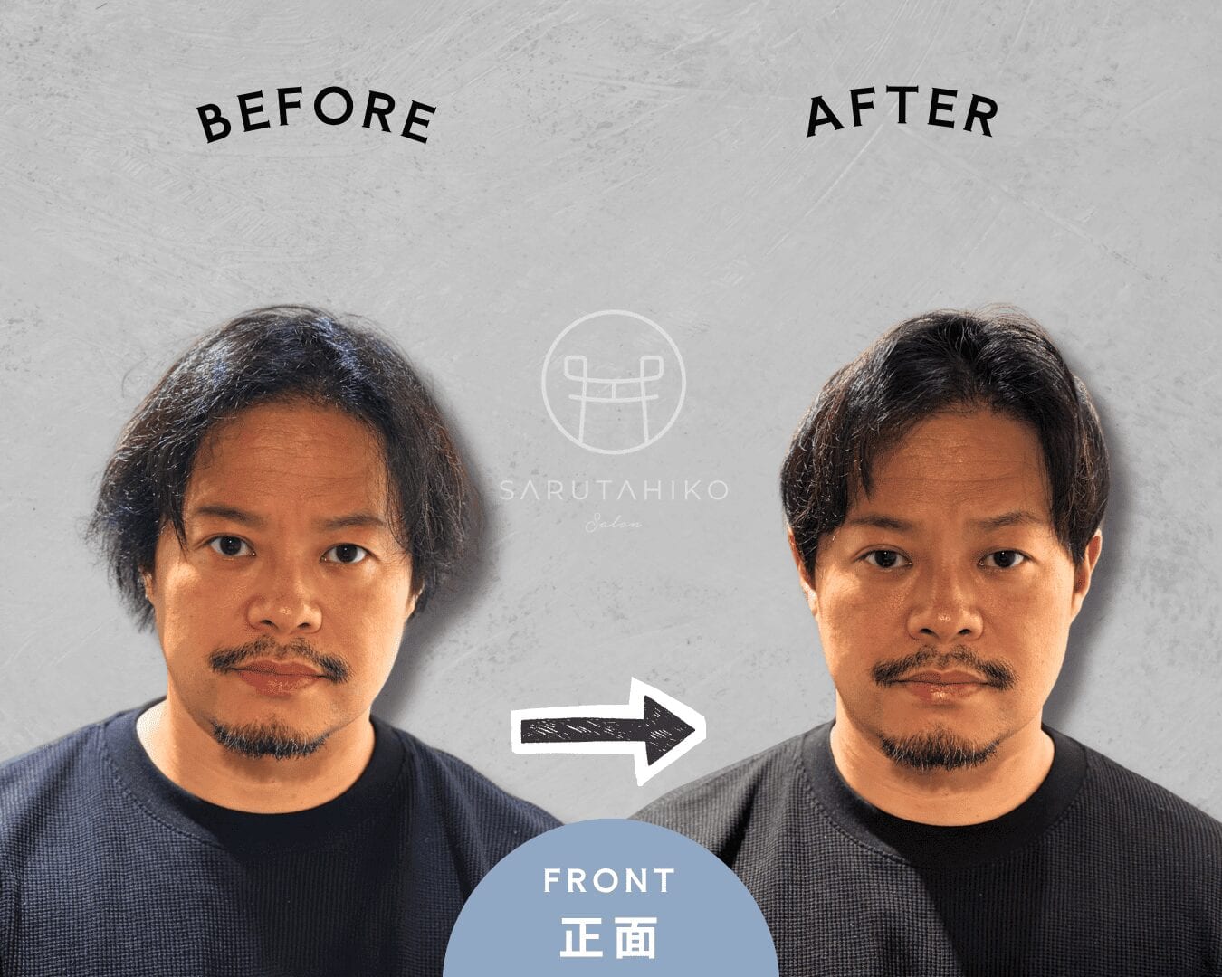 つむじ割れと頭頂部薄毛を自然にカバーした40代男性のカット前後（正面）