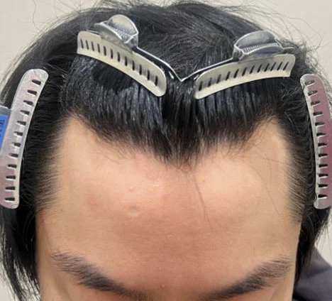 アスク井上クリニック提供症例 2300G 半年後の生え際写真