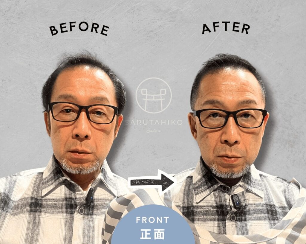 つむじ薄毛にお悩みの薄毛男性のカット前後の写真（正面）