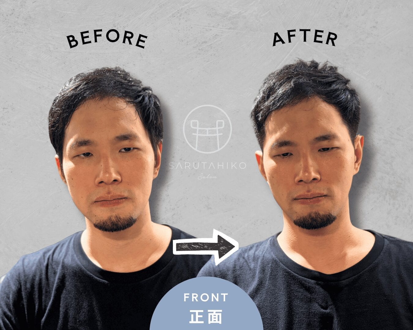 30代男性のM字薄毛を生え癖と毛流れで自然にカバーしたベリーショートの正面ビフォーアフター