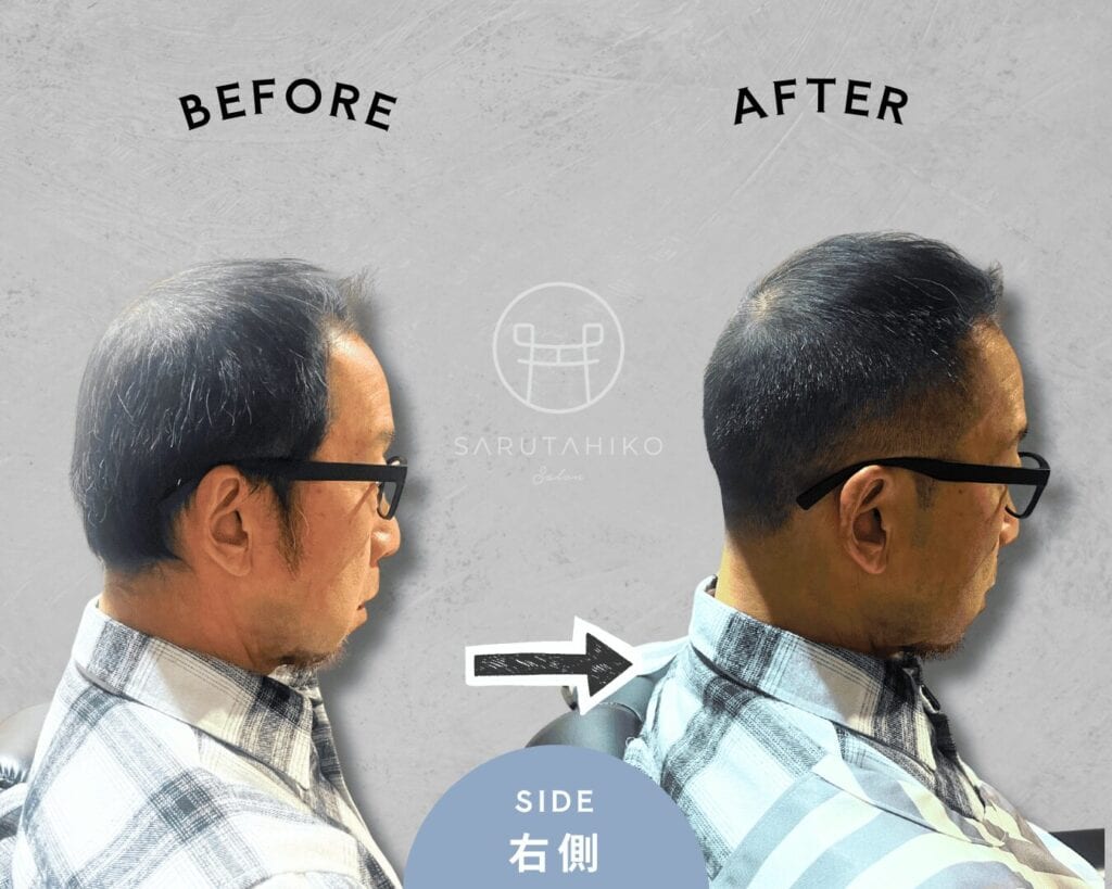 つむじ薄毛にお悩みの薄毛男性のカット前後の写真（右側）