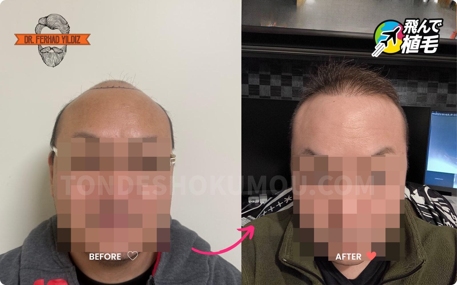 飛んで植毛から提供された症例写真1のBefore/After