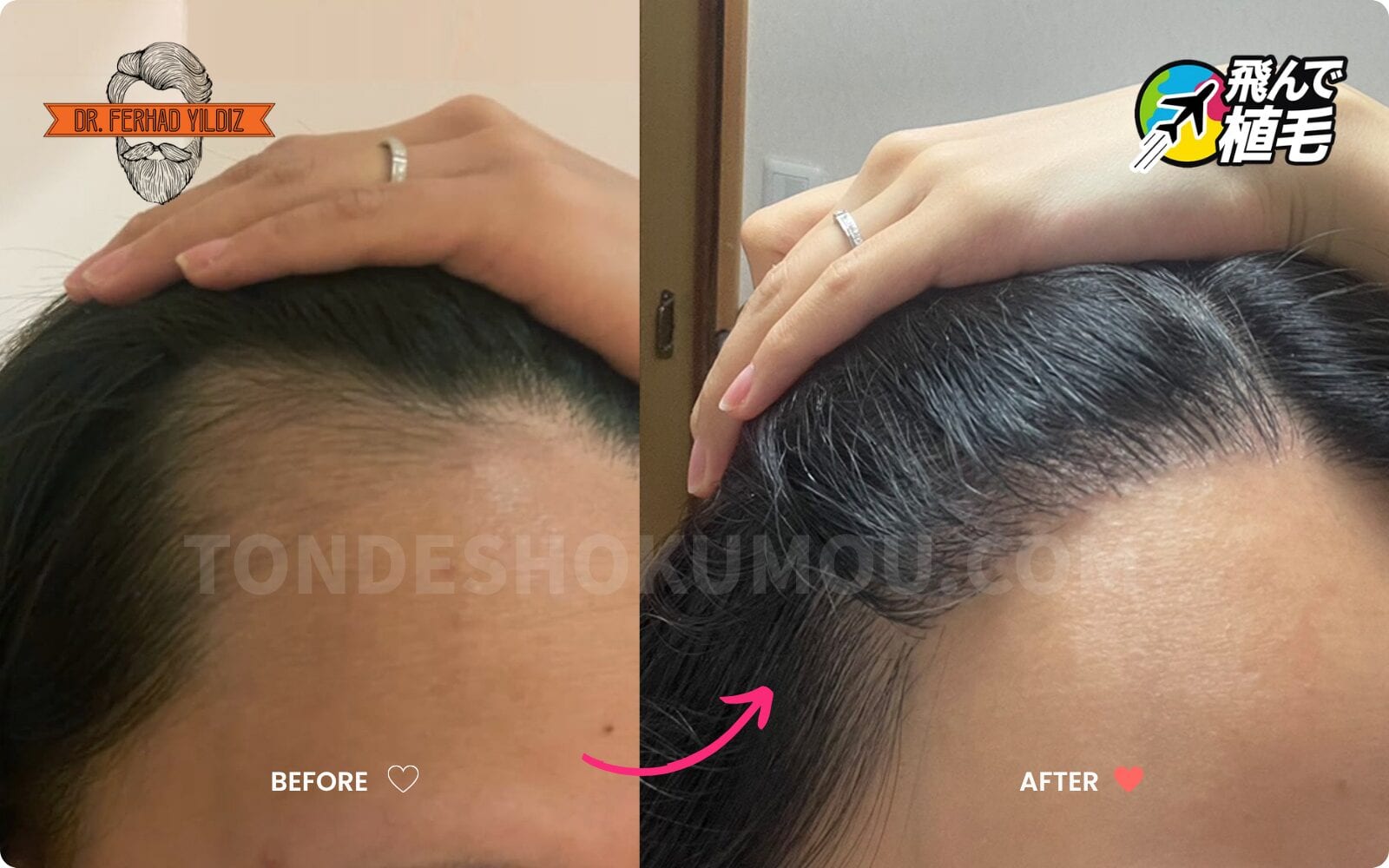 飛んで植毛から提供された症例写真2のBefore/After