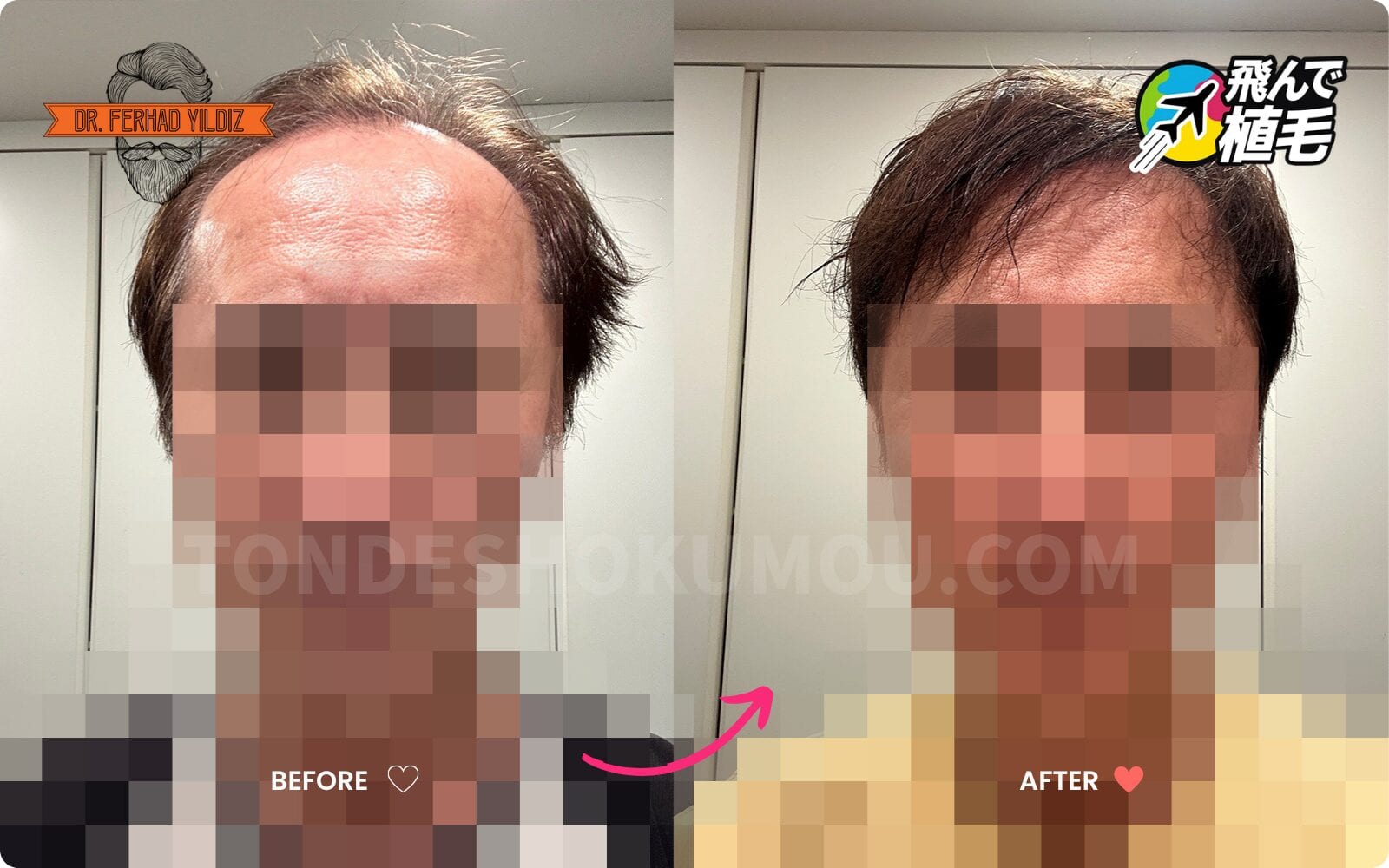 飛んで植毛から提供された症例写真3のBefore/After
