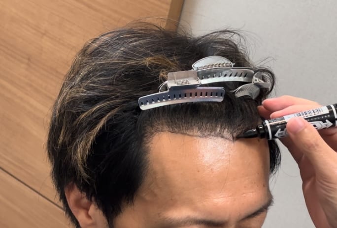 アスク井上クリニックで生え際のラインを確認しながらデザインする様子